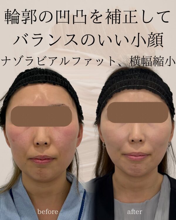 101 ナゾラビアルファット除去 × 顔の横幅縮小