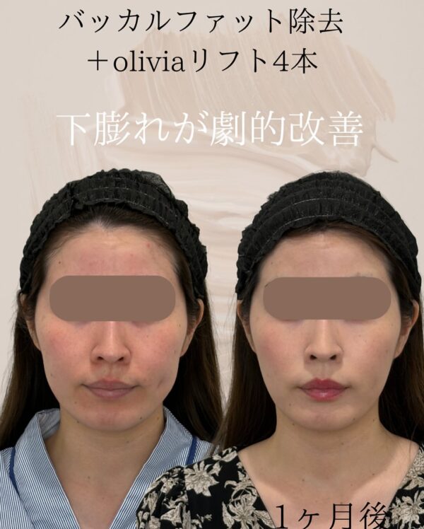 102 バッカルファット除去 × Olivia lift