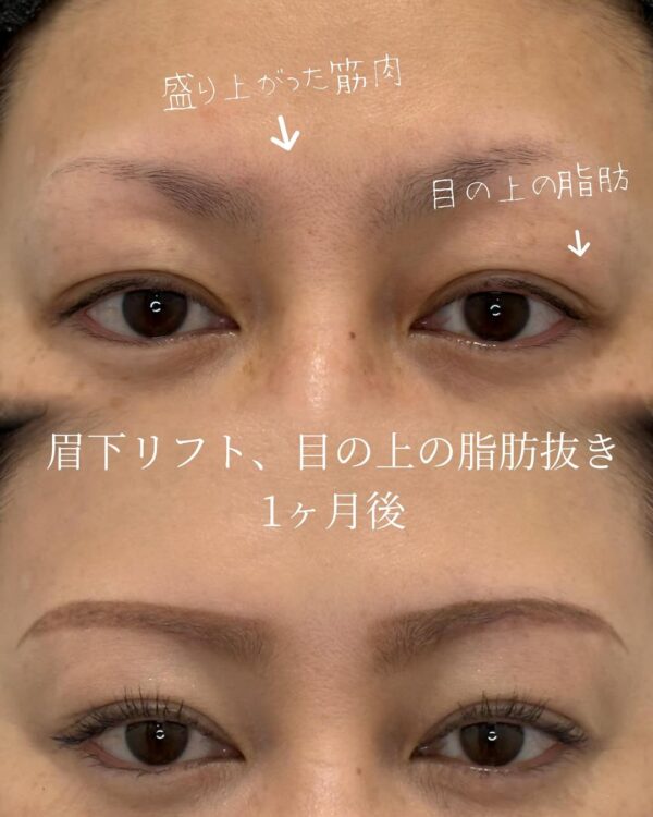 105 眉下リフト