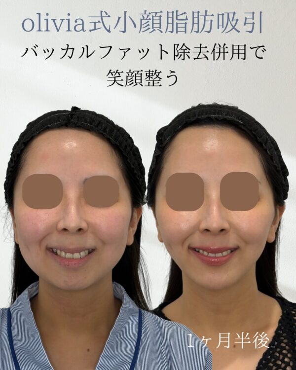 106 Olivia式小顔脂肪吸引 × バッカルファット除去