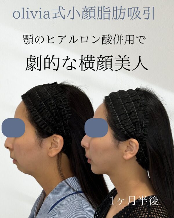 107 Olivia式小顔脂肪吸引 × バッカルファット除去 × ヒアルロン酸