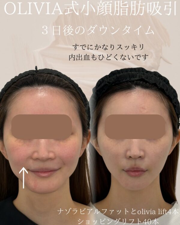 93 Olivia式小顔脂肪吸引 × ナゾラビアルファット除去 × ショッピングリフト × Olivia lift