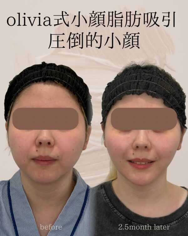 94 Olivia式小顔脂肪吸引 × ペリカンリフト × ナゾラビアルファット除去 × Olivia lift × ヒアルロン酸