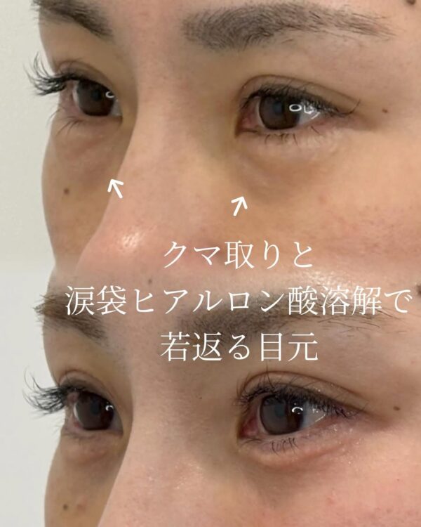 95 クマ取り × ヒアルロニダーゼ × ヒアルロン酸