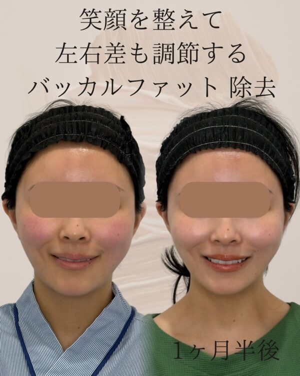 97 Olivia式小顔脂肪吸引 × バッカルファット除去